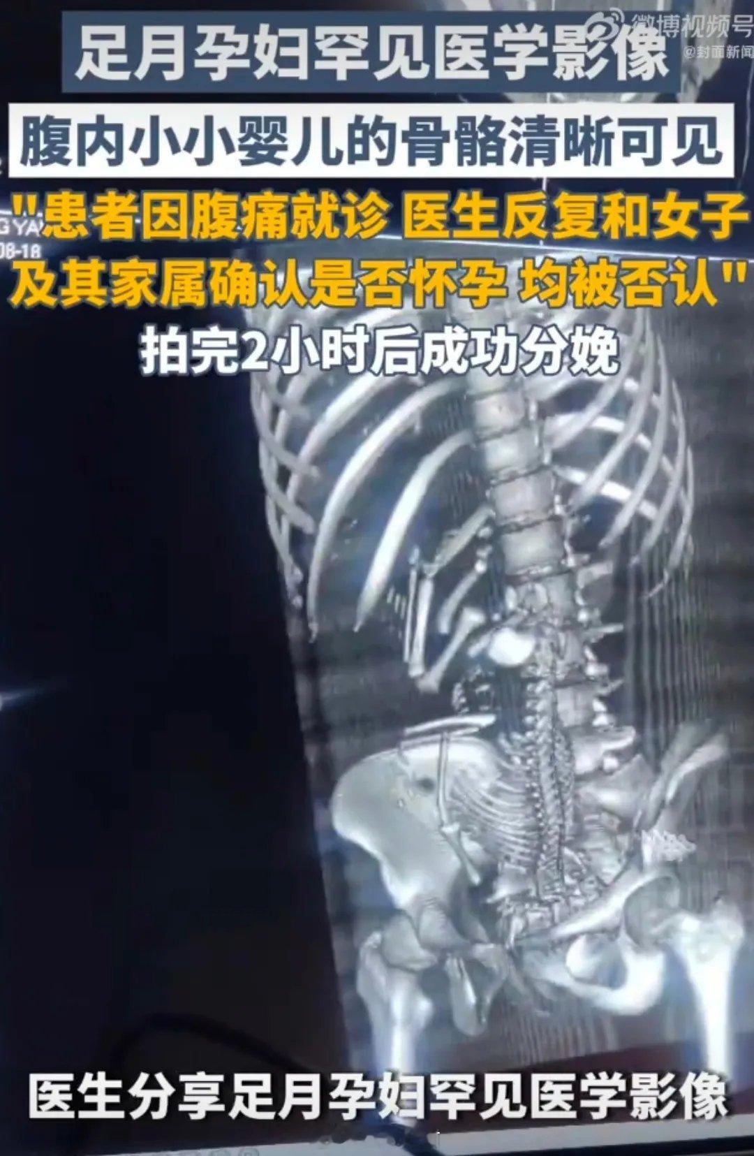 别人怀个孕真简单，很多人怀孕提心吊胆十个月，实在不明白，足月的孩子产妇肚子看不出