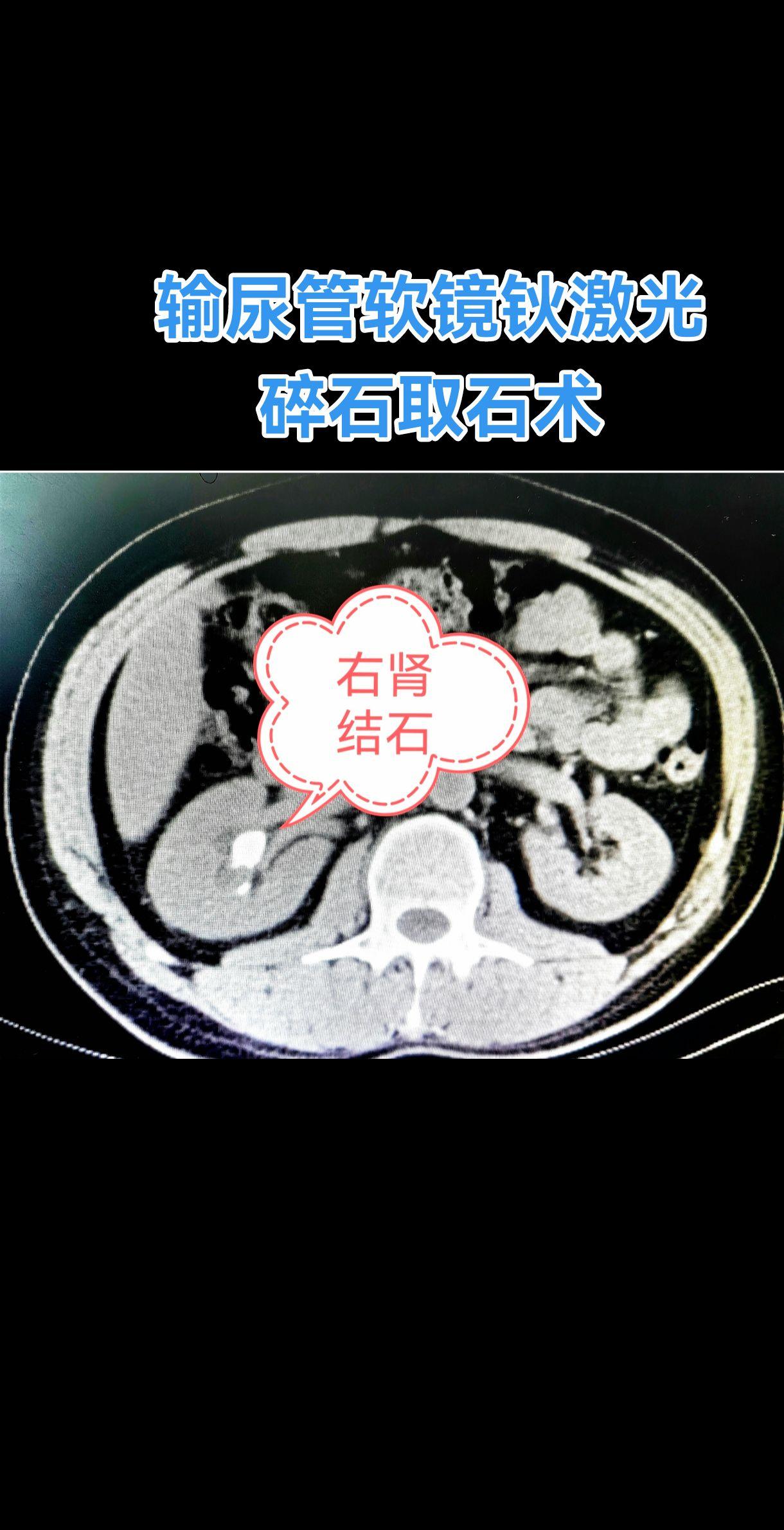 输尿管软镜钬激光碎石取石术。