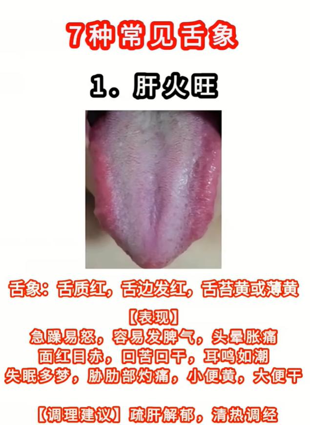 简单舌诊科普，7 种典型舌象，看看你是哪一类