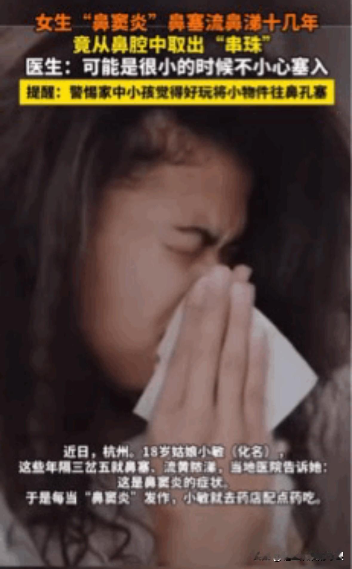 惊讶！鼻腔深处有颗串珠。近日，浙江杭州的18岁姑娘小敏，这些年来隔三差五就流黄脓