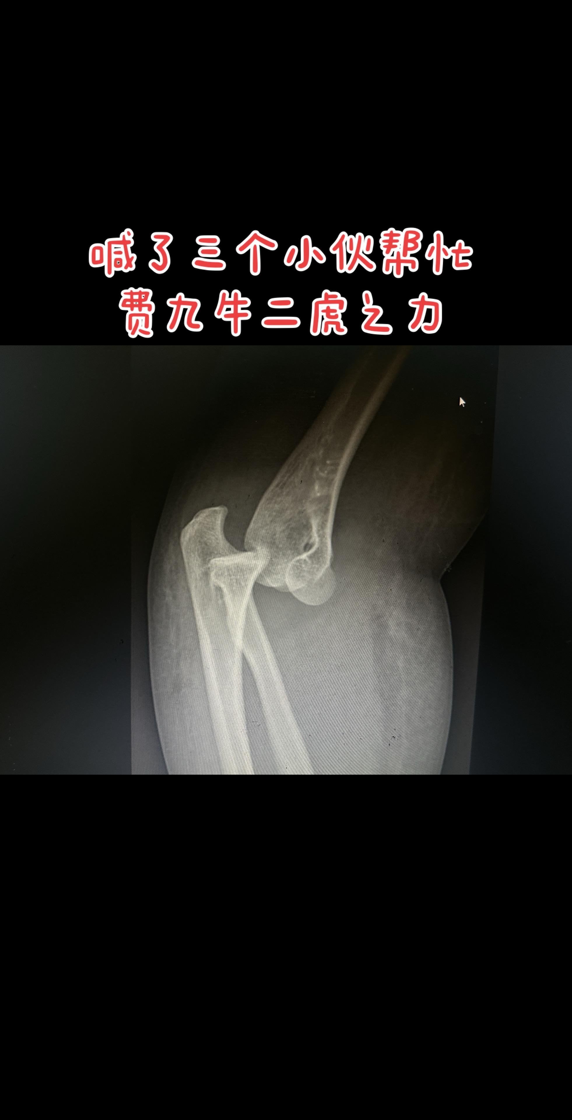 肘关节脱位复位费小伙子。下雨摔倒，复位确实需要一把子力气