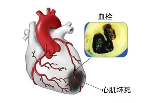 真心痛（急性心肌梗塞）的中医辨证论治，来对照看看吧 1. 寒滞心脉 症状：胸痛掣