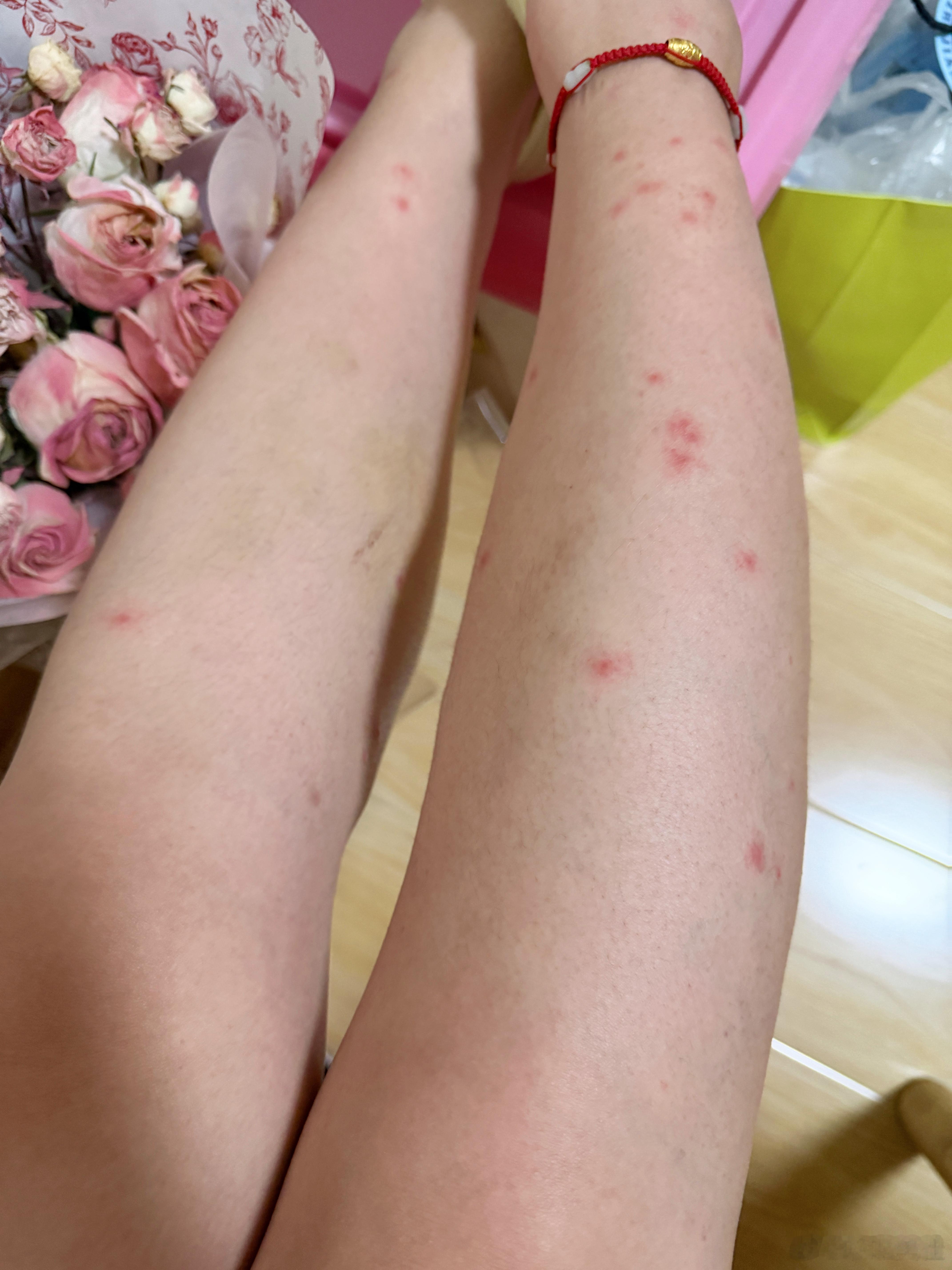 人好像在焦虑的时候身体就会发生变化，刚出门就感觉腿痒，仔细一看发现涨了很多红色小