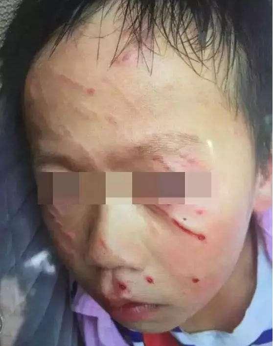 2017年，武汉两个男孩在学校里打架，一男孩脸被抓破相了都，于是老师便把家长喊了