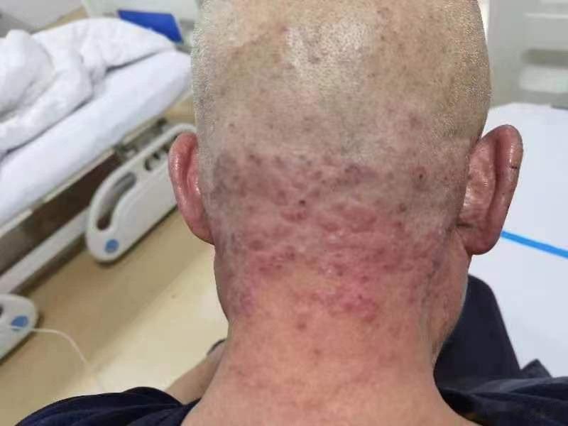 【很有意思的医案～湿疹】这个老爷子，湿疹很严重，尤其是集中到后颈部，晚上痒的厉害