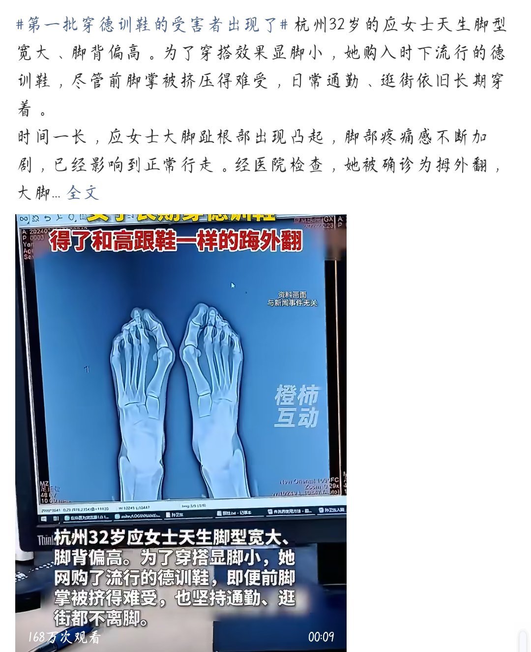 第一批穿德训鞋的受害者出现了不合适就不能买大一码或者是半码吗？还要硬穿？ ​​​