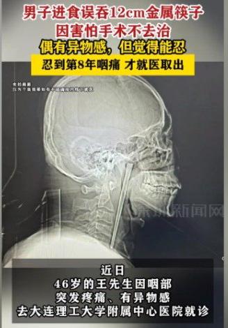 46岁的大连王先生，硬生生把一根12厘米的金属筷子咽进了喉咙，一藏就是8年。8年