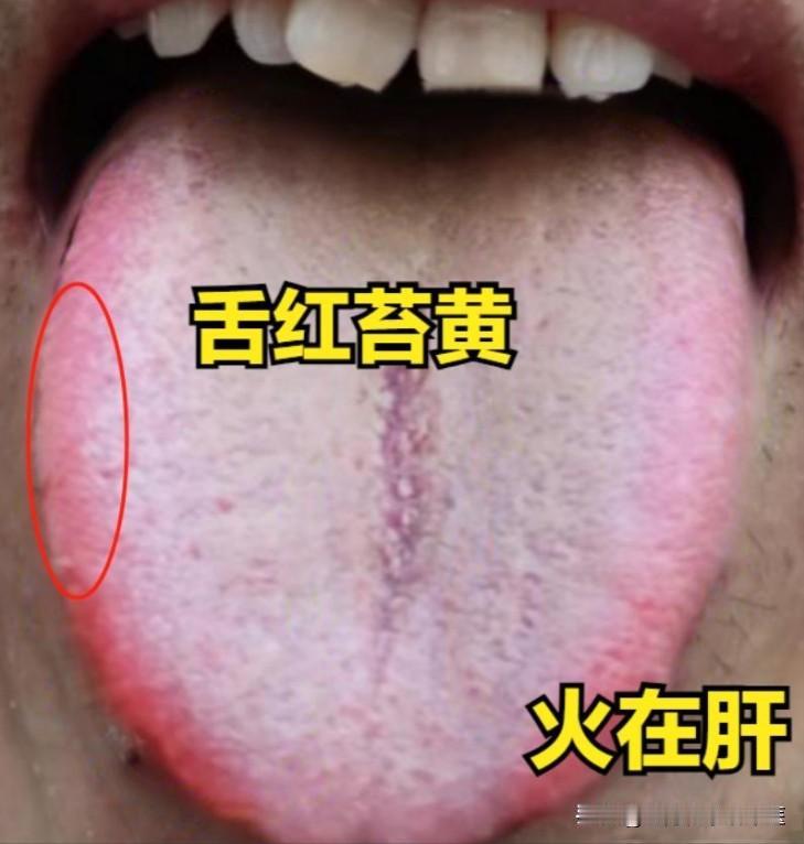 火在肝用蒲公英，火在心用竹叶，火在肠用马齿苋，祛火不伤身！

1、火在肝——蒲公
