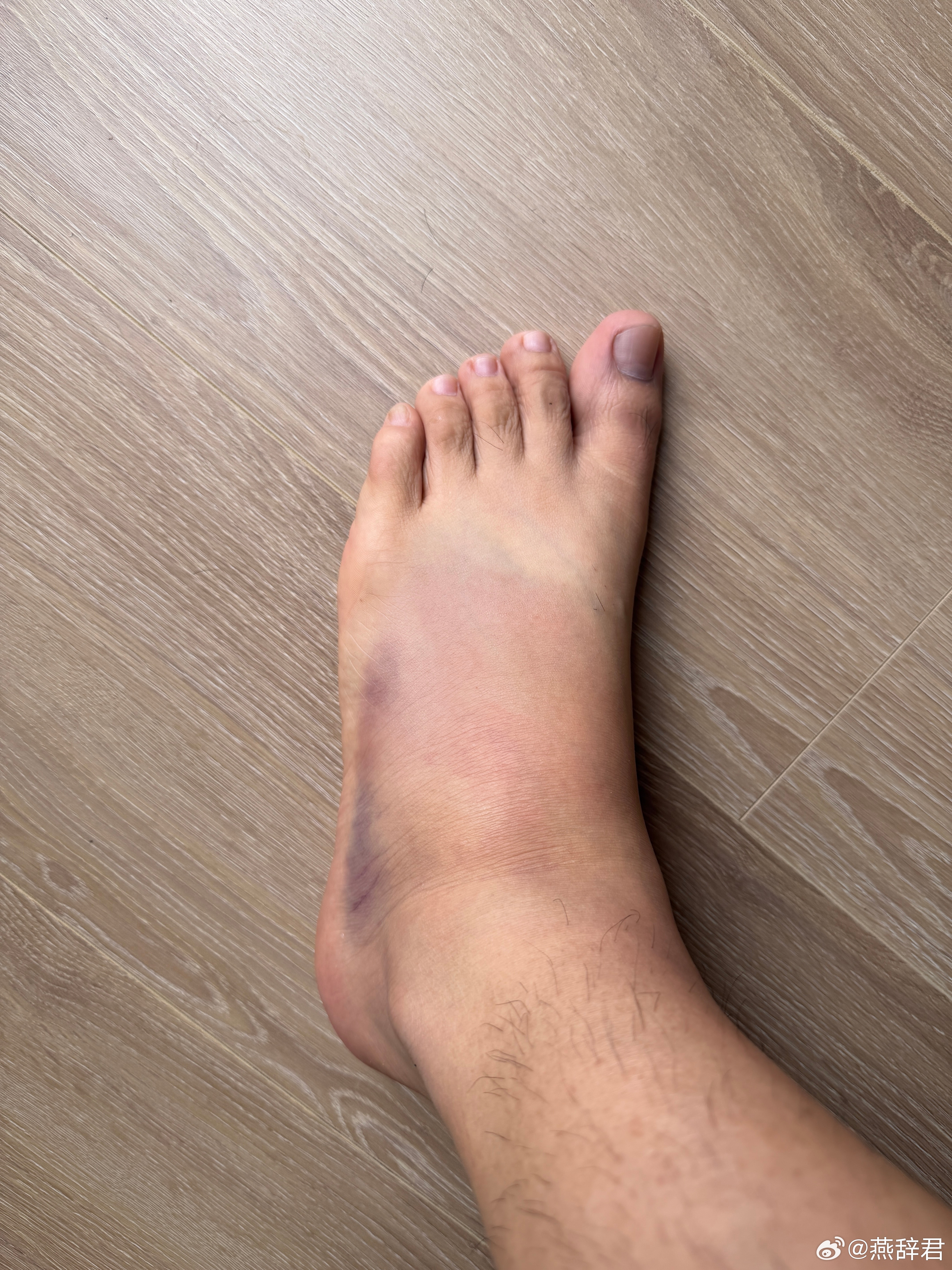 崴脚两天后，虽然还有一些疼痛，但是基本可以正常行走了，这黑青看着太恐怖了 