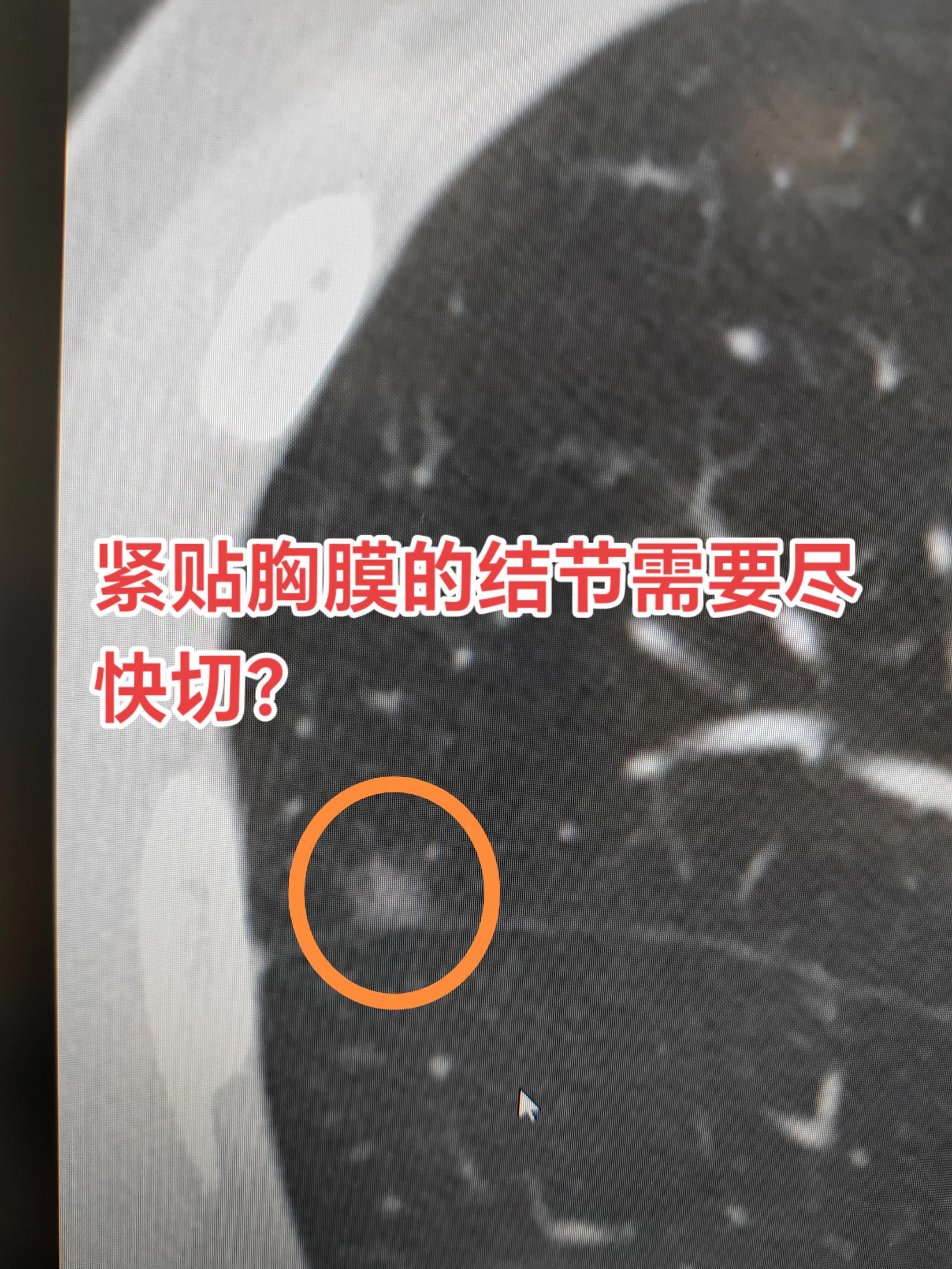 紧贴胸膜的肺结节需要尽快切？体检发现紧贴胸膜的肺结节，是不是就意味着离...