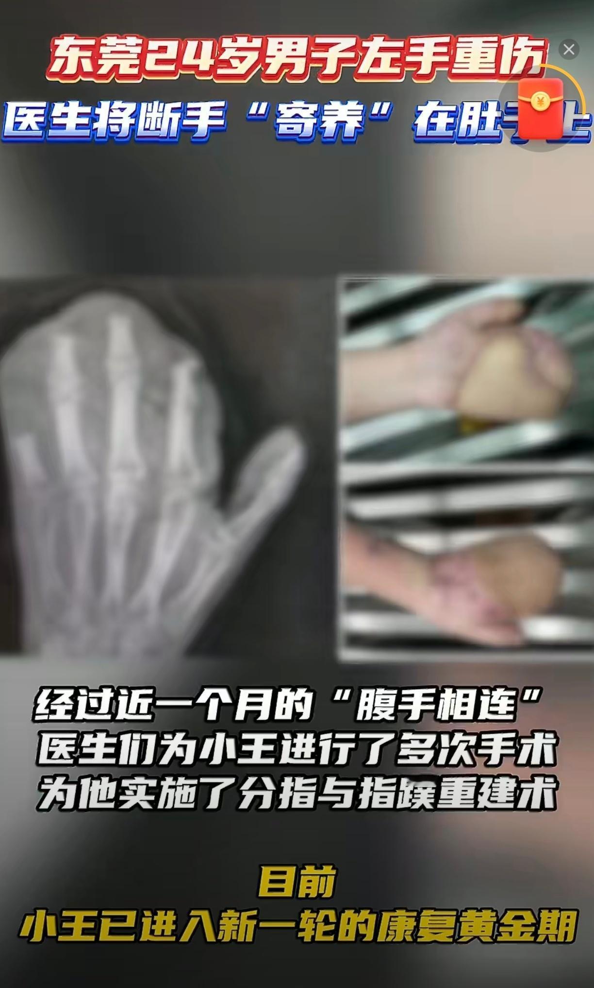 【东莞24岁男子断手"寄养"腹部一个月！医生用皮瓣技术成功保肢】

近日，广东东