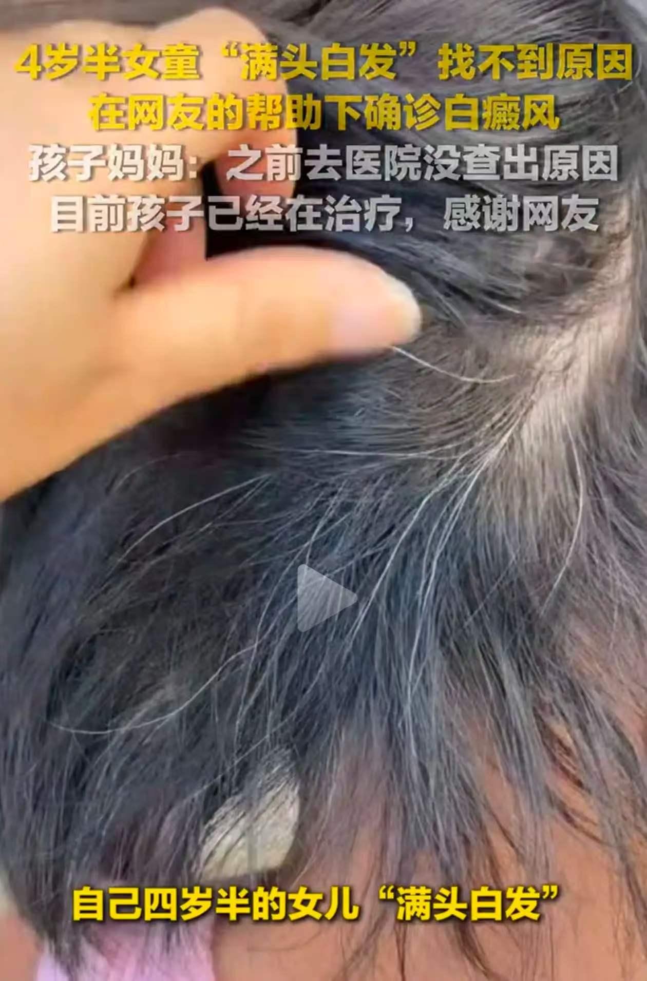贵州毕节，一个4岁半的女孩，头发莫名白了大半年，还越白越多，可多次检查都查不出问