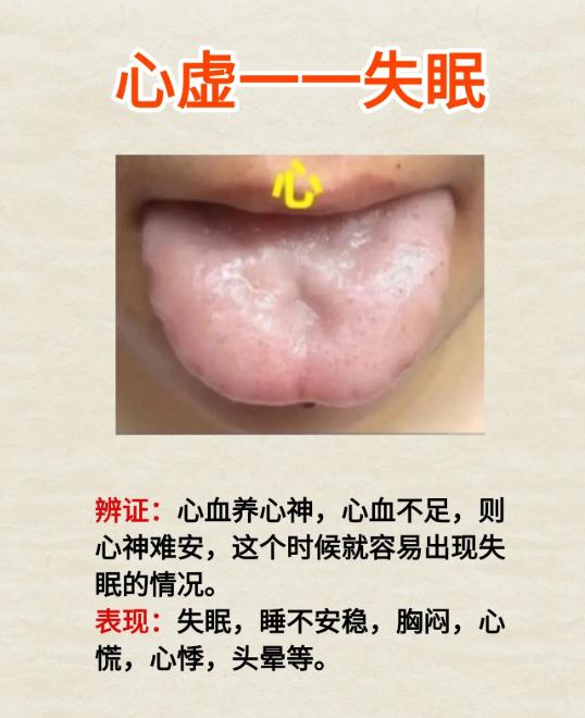 五脏虚了有信号！5 种舌象对应不同问题