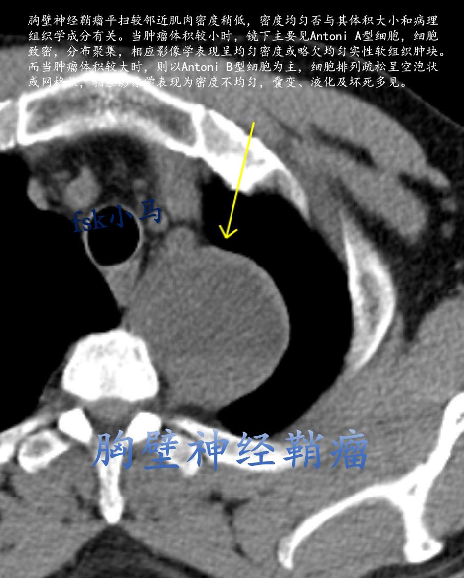 胸壁神经鞘瘤