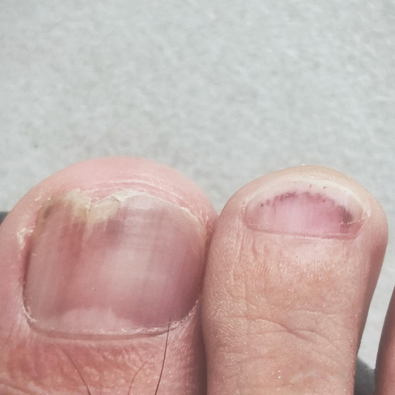 跑步人的经历，不跑步的人“享受”不到的。
第二次脚指头（指甲）发黑。第一次应该是