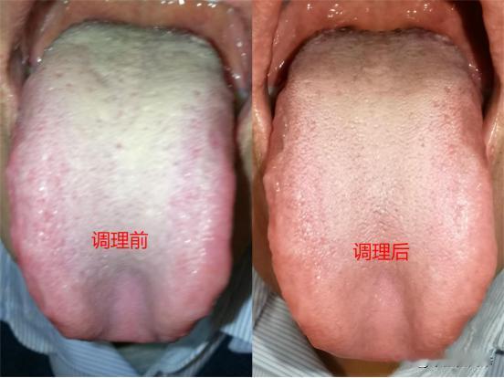 舌象大变样，用对方法只需要1周！今天分享给你！
第一步：清理白厚苔、扫清体内壅堵