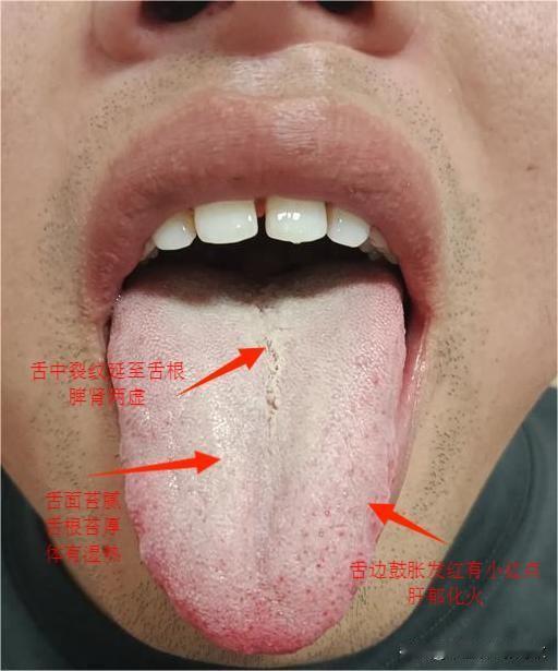 睡不着？内火大？牵一发而动全身，长此以往，补都补不回来[发怒][发怒]
最近问诊