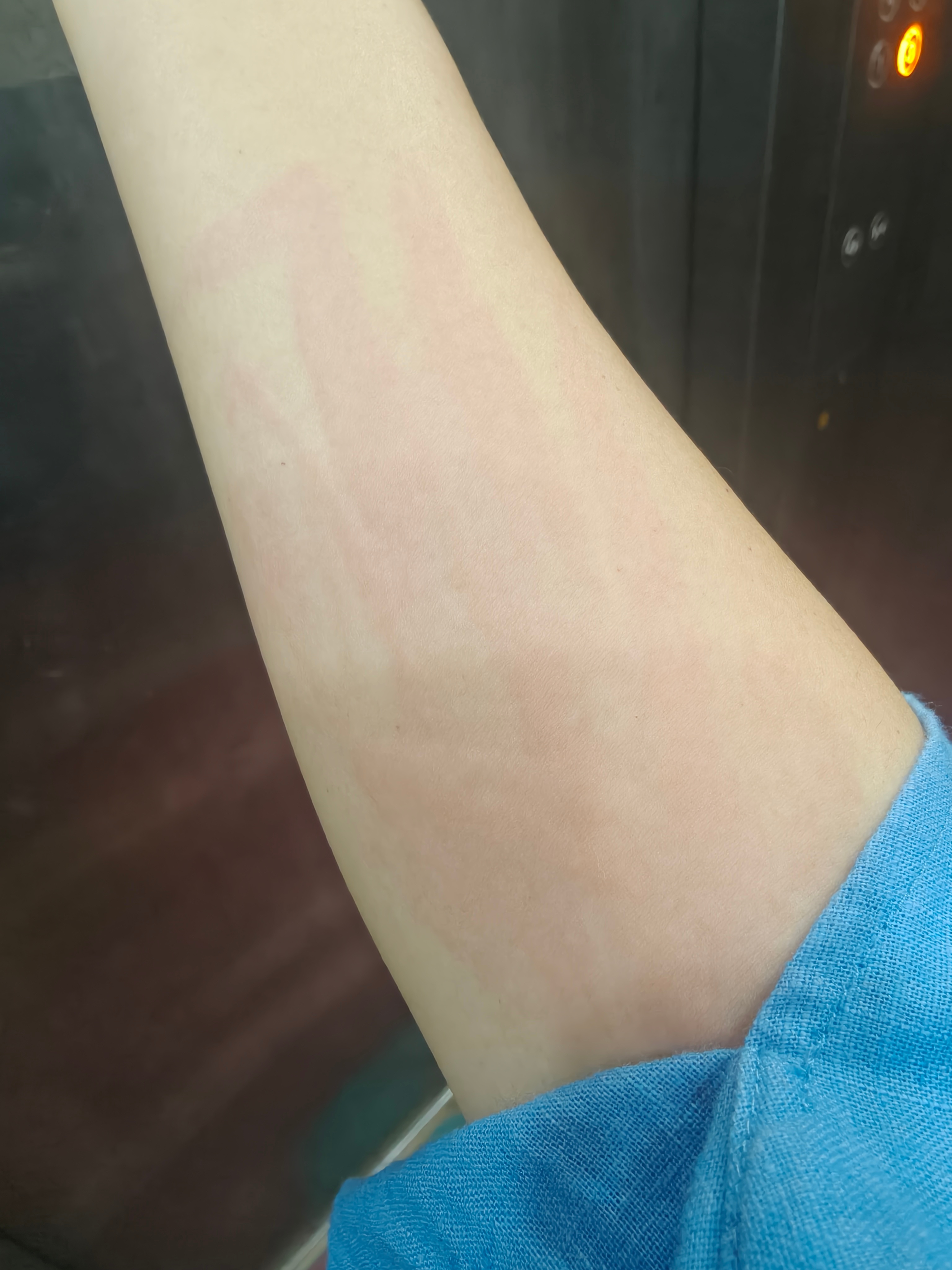 就只是偷吃了两勺甜酒酿汤圆，荨麻疹就发作了！哎！国产手机，你能别自动美颜吗！！！