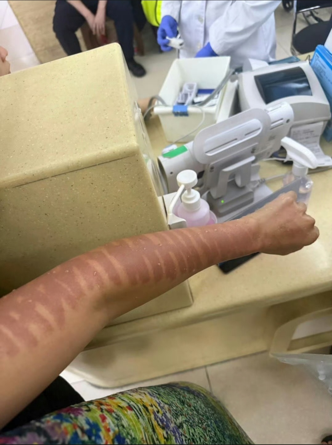 千里寻椰 光子嫩肤二度烧伤从图片中可以看到，她的左手手臂有明显的烧伤痕迹，皮肤呈