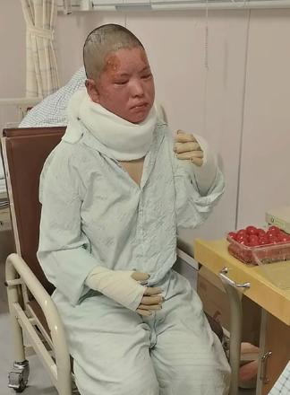 浙江烧伤妈妈终于露脸了！！！

今天是她转到衢州衢化医院的第二天，今天她老公拍她