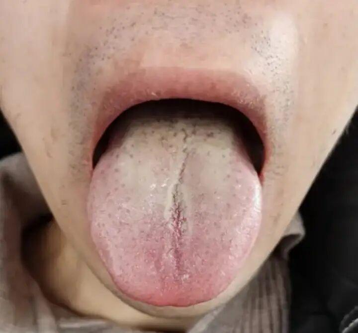 舌象反映肝肾表象，脾虚是元凶？
观察此舌象，我们首先注意到的是下焦的痰湿过重和肝