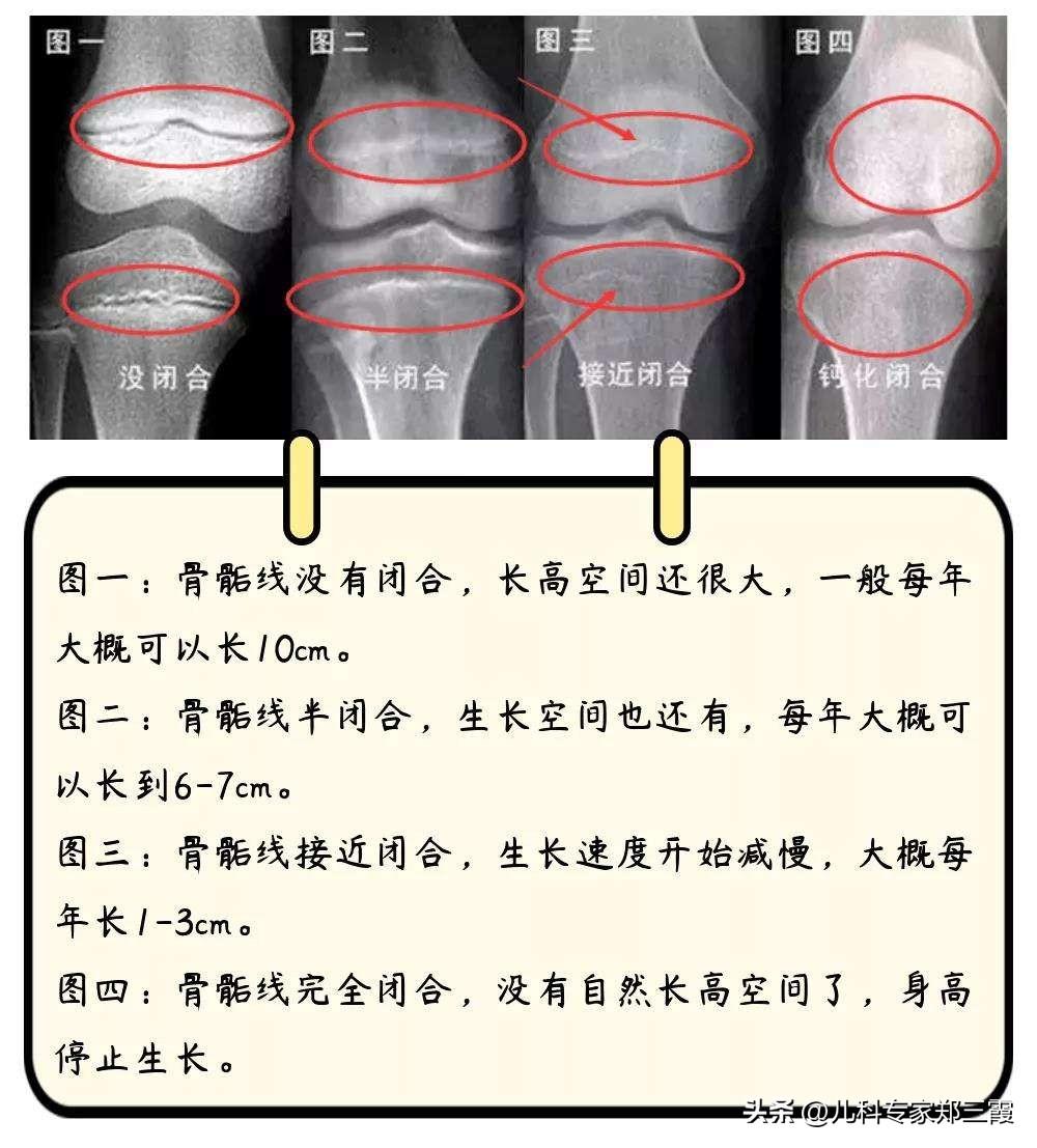 骨骺线快闭合，中医干预4个月长高3厘米！
 
今年上半年，我接诊了一个男孩，身高