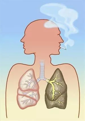 慢阻肺：小心！藏在咳嗽背后的健康杀手