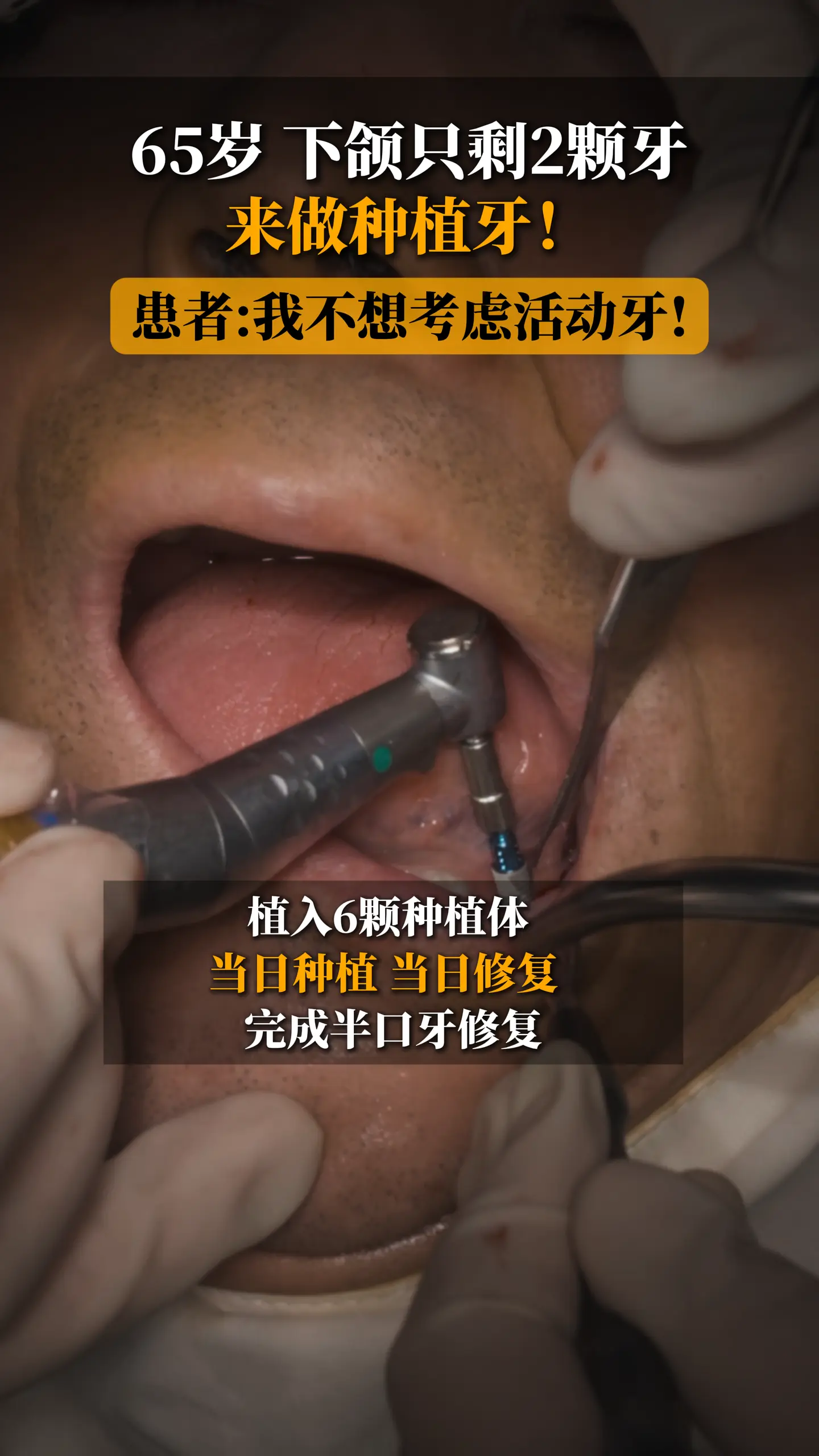 65岁，下颌只剩2颗牙了，来做种植牙！。该患者10多年前有多颗牙因龋坏...