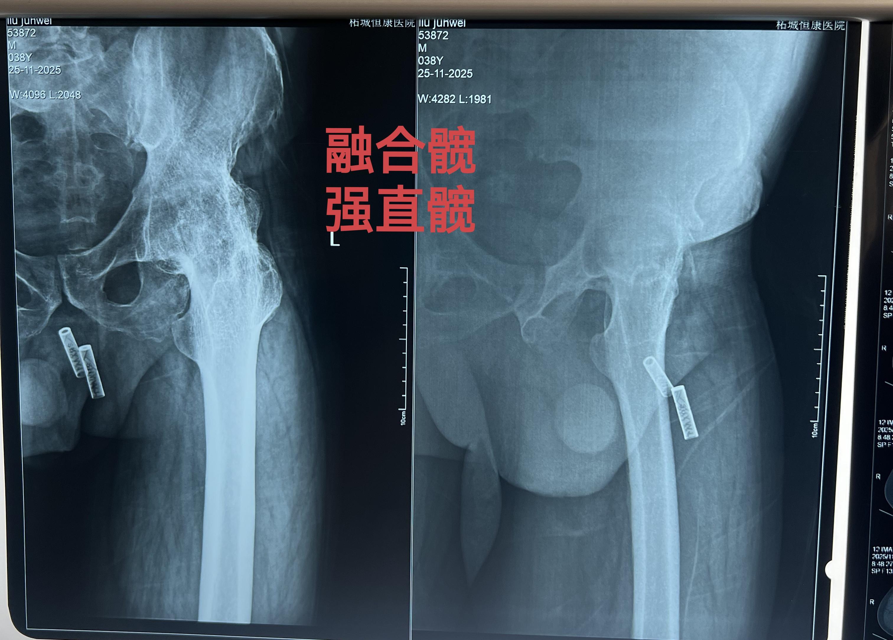 融合髋，髋关节置换。初次THA两个天花板手术之一，融合髋。可怜的孩子...