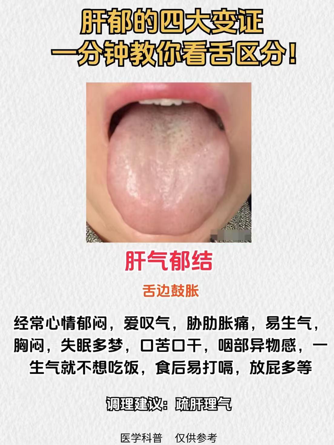 肝郁的四大变证，一分钟教你看舌区分！#健康##涨知识##科普##中医##舌诊##