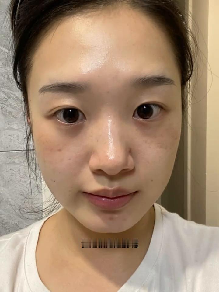 这是我几年前生完一胎后长的黄褐斑，像这种颧骨附近成片的斑真的特别难搞。经过这几年