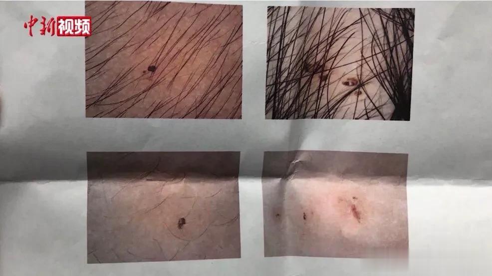 【最新消息！#孩子身上现不明针眼幼儿园园长被免#】内蒙古呼和浩特新城区教育局通报