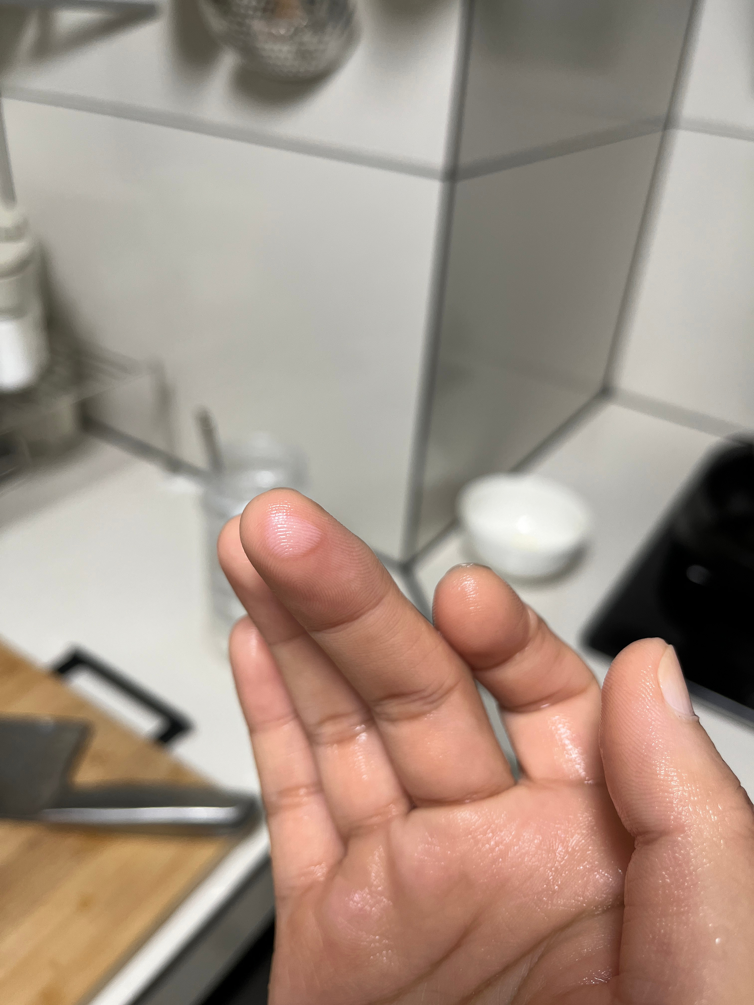 昨天做饭中指和大拇指手指指腹被烫伤了。原因说起来有点可笑。抠门到家是要付出代的。