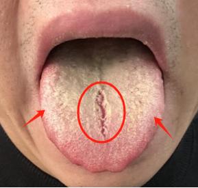 龙胆泻肝丸搭配好了，清湿热事半功倍！

1、龙胆泻肝丸+藿香清胃胶囊
 
作用：