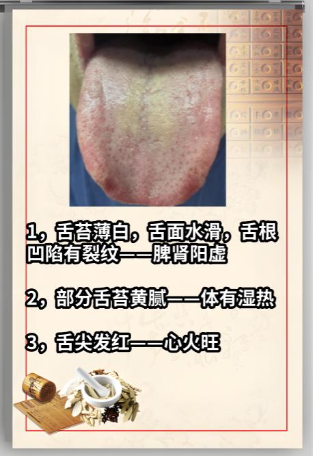 舌象分析——看完66个舌象！

今天继续来给大家看舌象！

记得把舌头照片放在下