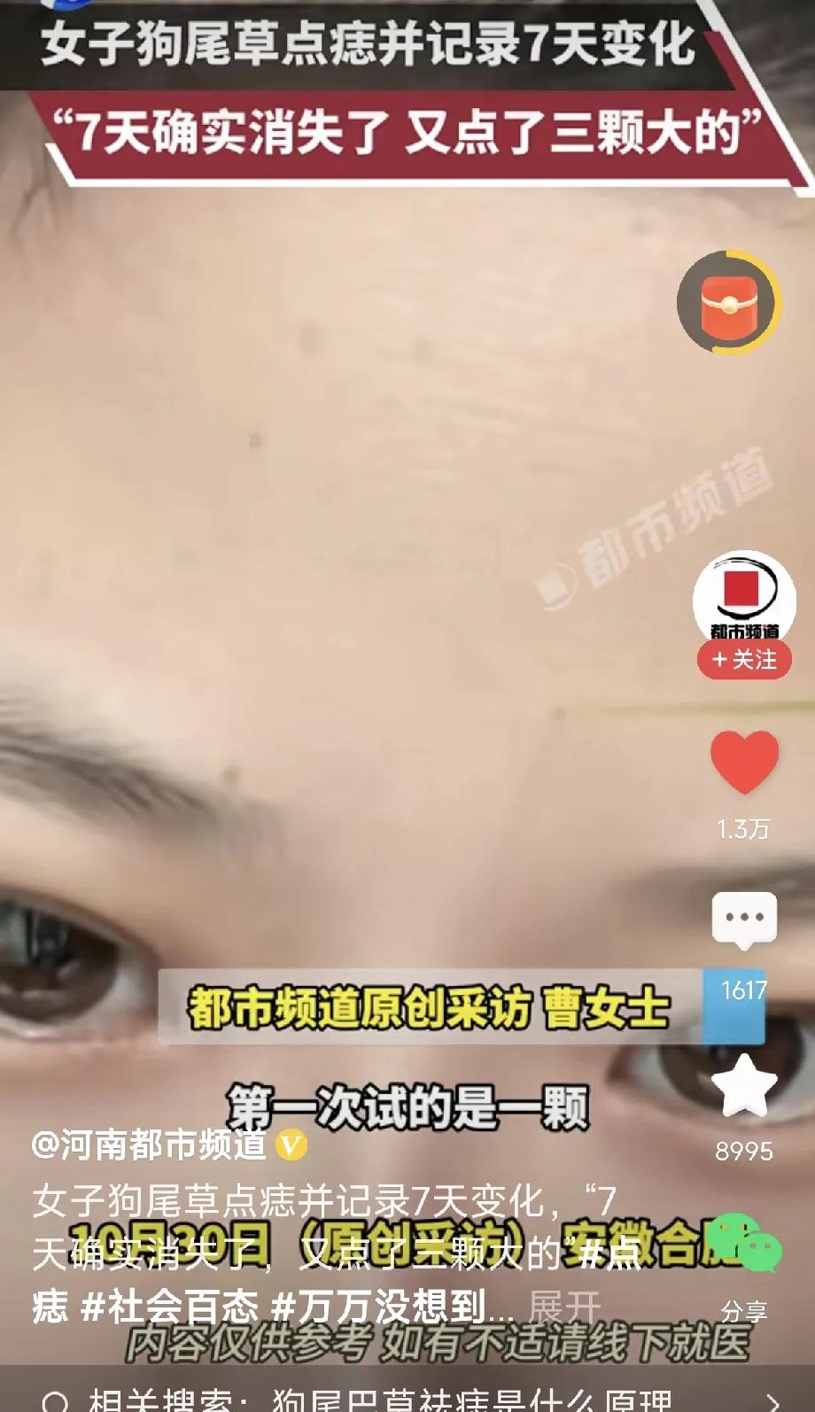 讲真的，近期“狗尾巴草点痣”超级火！
有人宣称用它来点痣效果很棒，而且不会留疤，