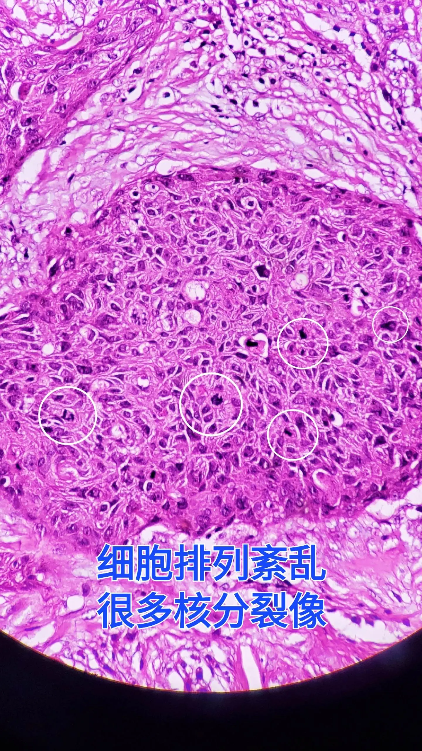 阴茎癌 鳞状细胞癌  细胞间桥