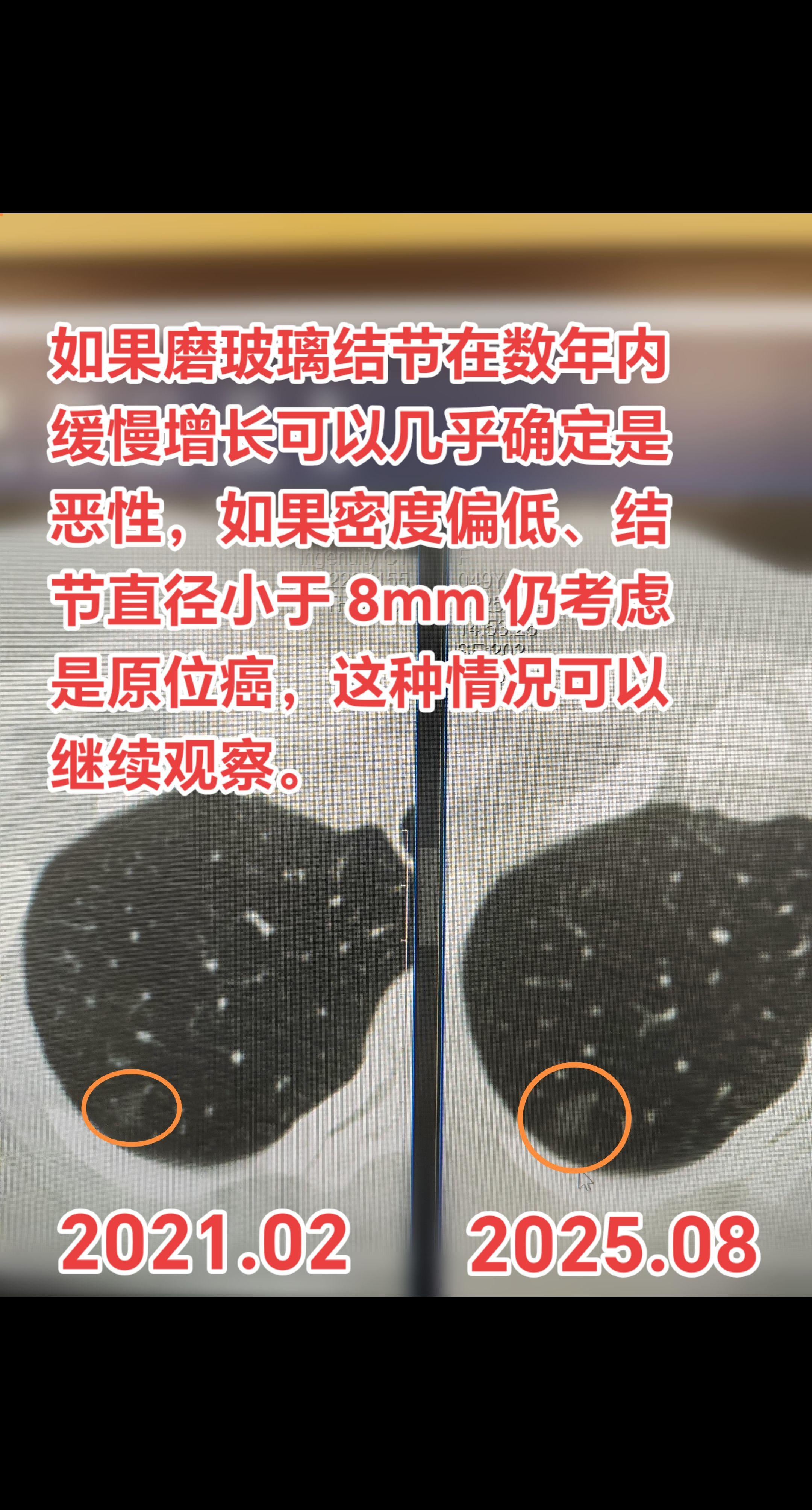 缓慢增长的磨玻璃结节要警惕恶性。如果磨玻璃结节在数年内缓慢增长可以几乎...