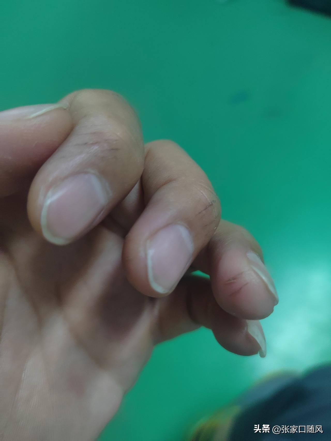 干我们这行有时真的挺难的，因为杂事太多，不注意就要受伤。

同事受破了，我说要注