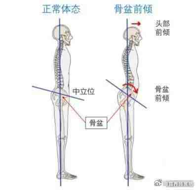 #大腿粗壮可能是骨盆前倾##健闻登顶计划# “骨盆摆正，核心收紧”腹部收不住，没