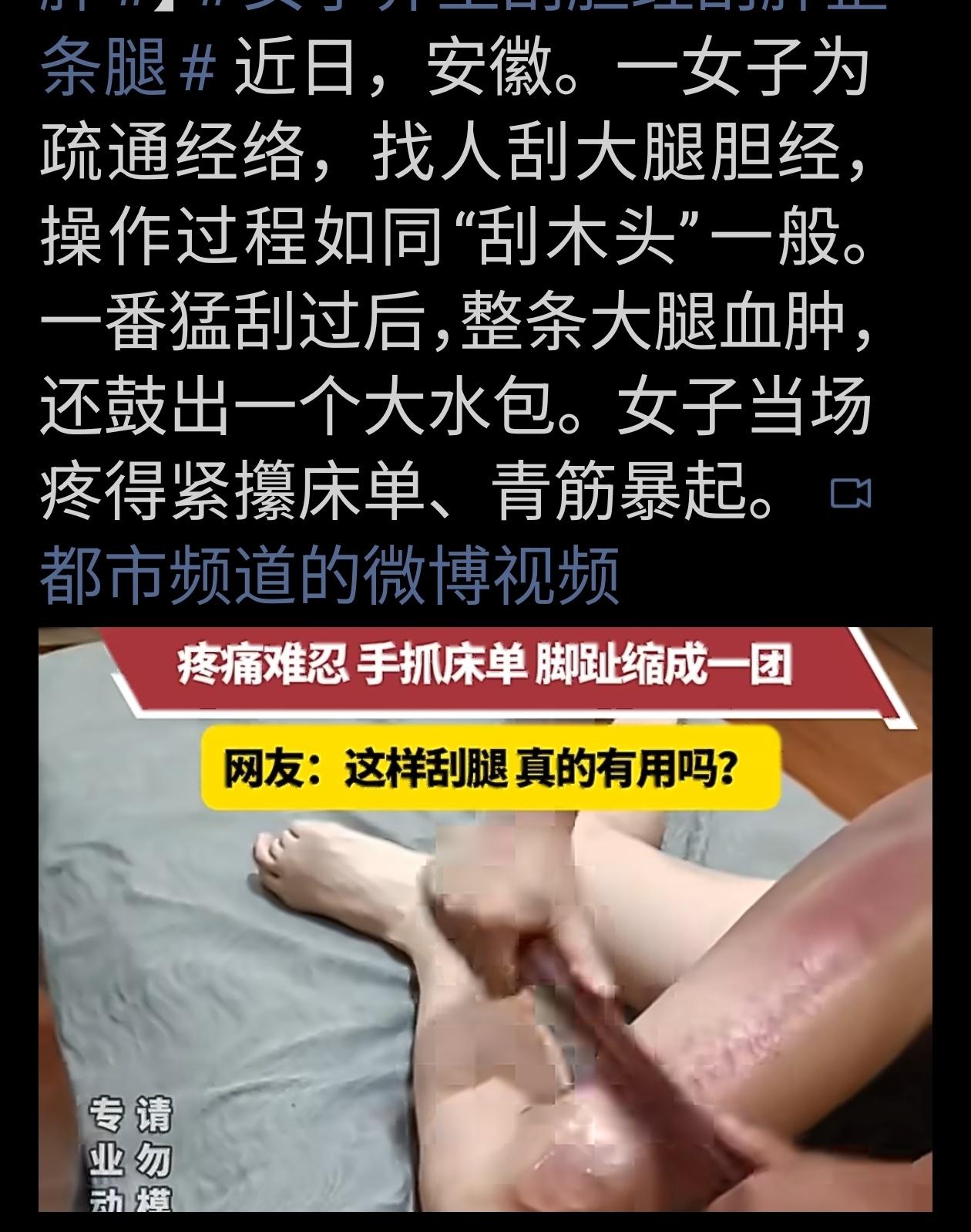 近日安徽一女子，为疏通经络，找人刮大腿内经红肿，造成大腿盲目刮痧伤身！
 
社会