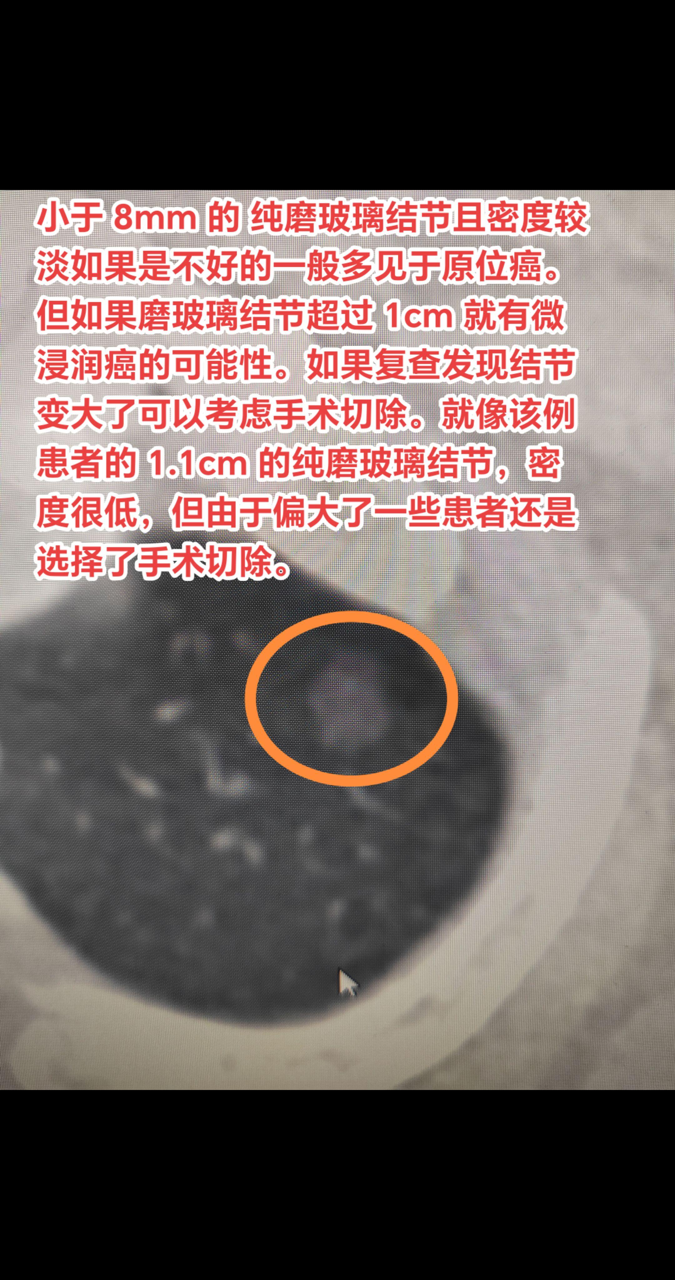 偏大纯磨玻璃结节也有微浸润的可能！小于 8mm 的 纯磨玻璃结节且密度...