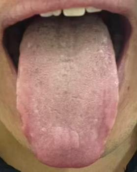 舌象淡胖、苔白厚腻，多见脾虚痰湿兼气血不足，男科相关调理优先顾护脾胃




