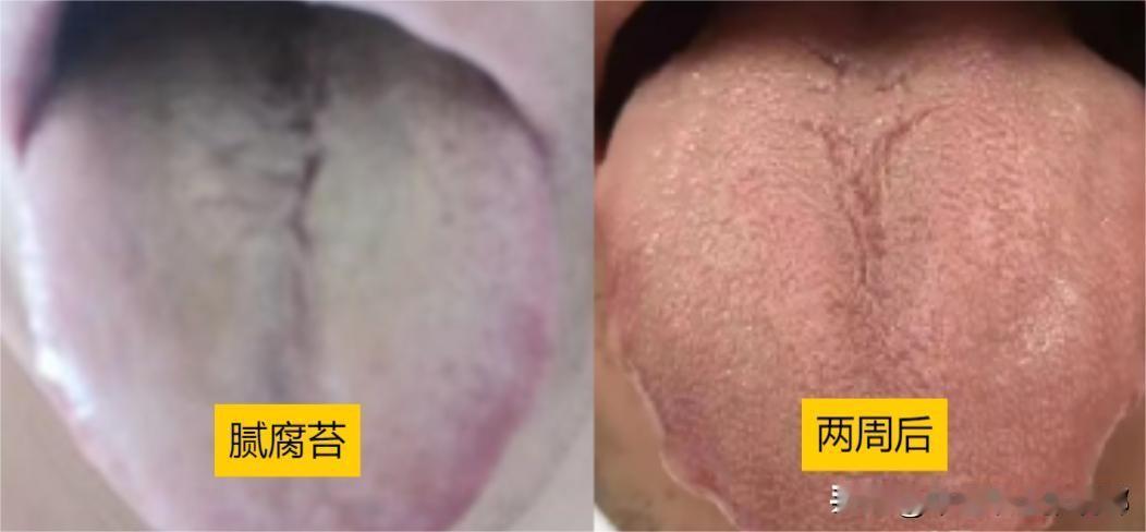 刮干净舌头上这些脏东西，我只用三周，其中大有乾坤！

第一张图片是患者半月前的舌