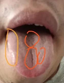 这种舌头一看啊，就是造的太厉害了，觉得自己年轻不怕，看看舌头上的裂纹堵多深了，想