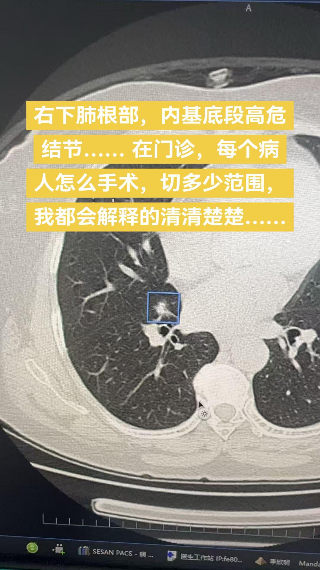 右下肺根部，内基底段高危结节…… 在门诊，每个病人怎么手术，切多少范围...