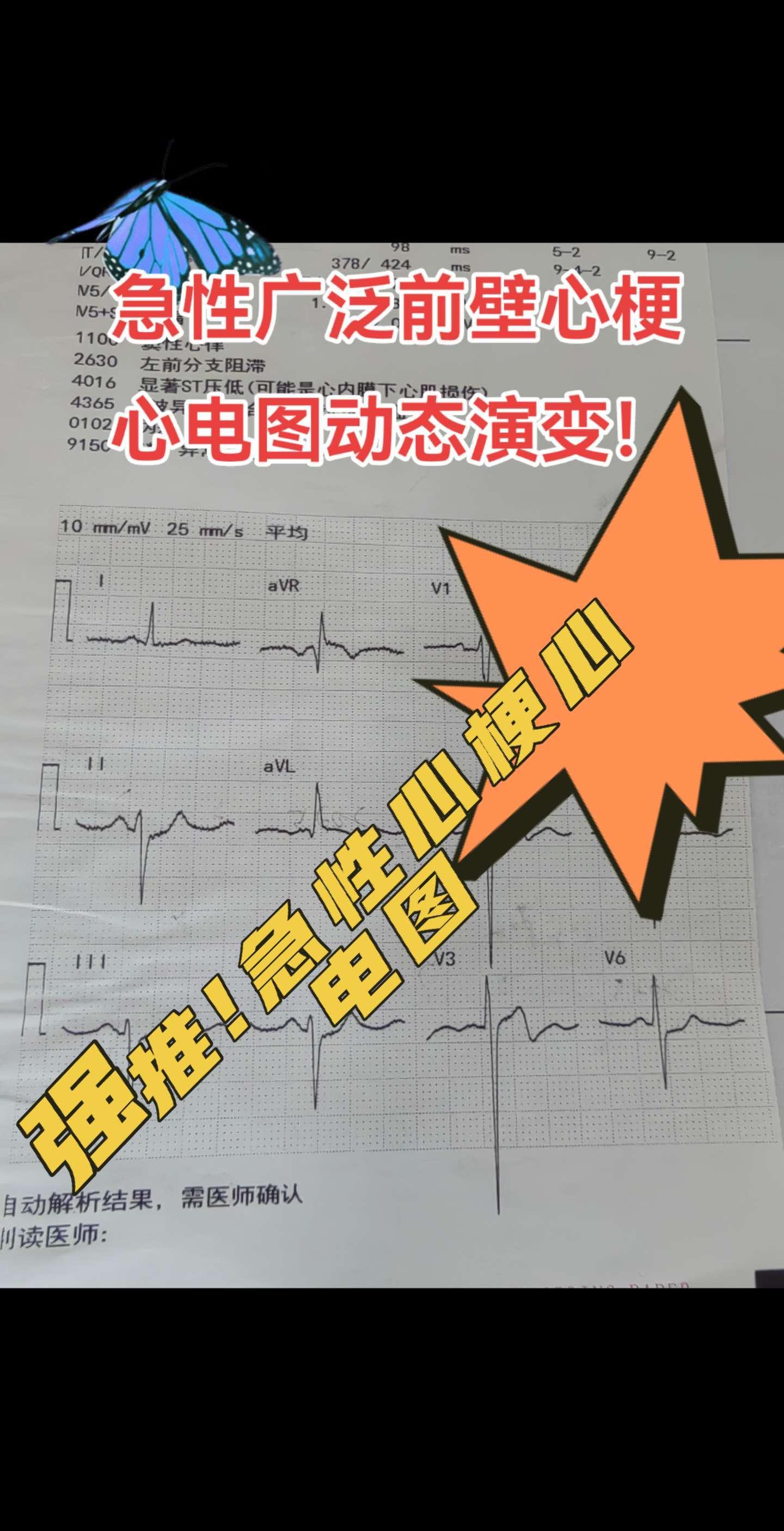 急性心梗。心电图动态演变