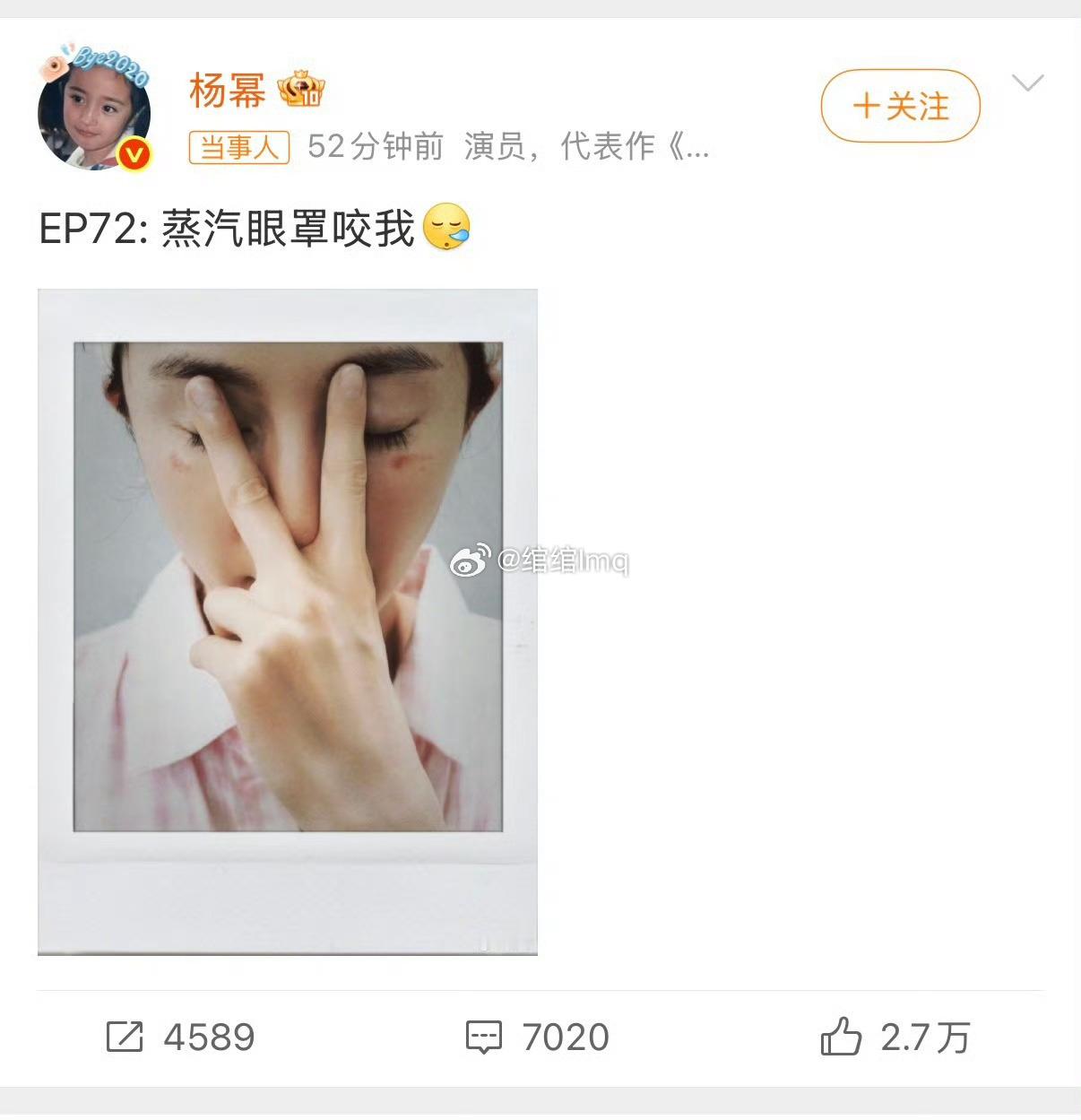 杨幂脸被蒸汽眼罩烫伤了杨幂脸被蒸汽眼罩烫伤了早在2022年，杨幂眼角就受伤了两个