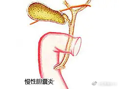 胆囊炎出现时，常见的几个信号！胆囊炎发作的时候，一般会比较明确的诱因，比如吃的比