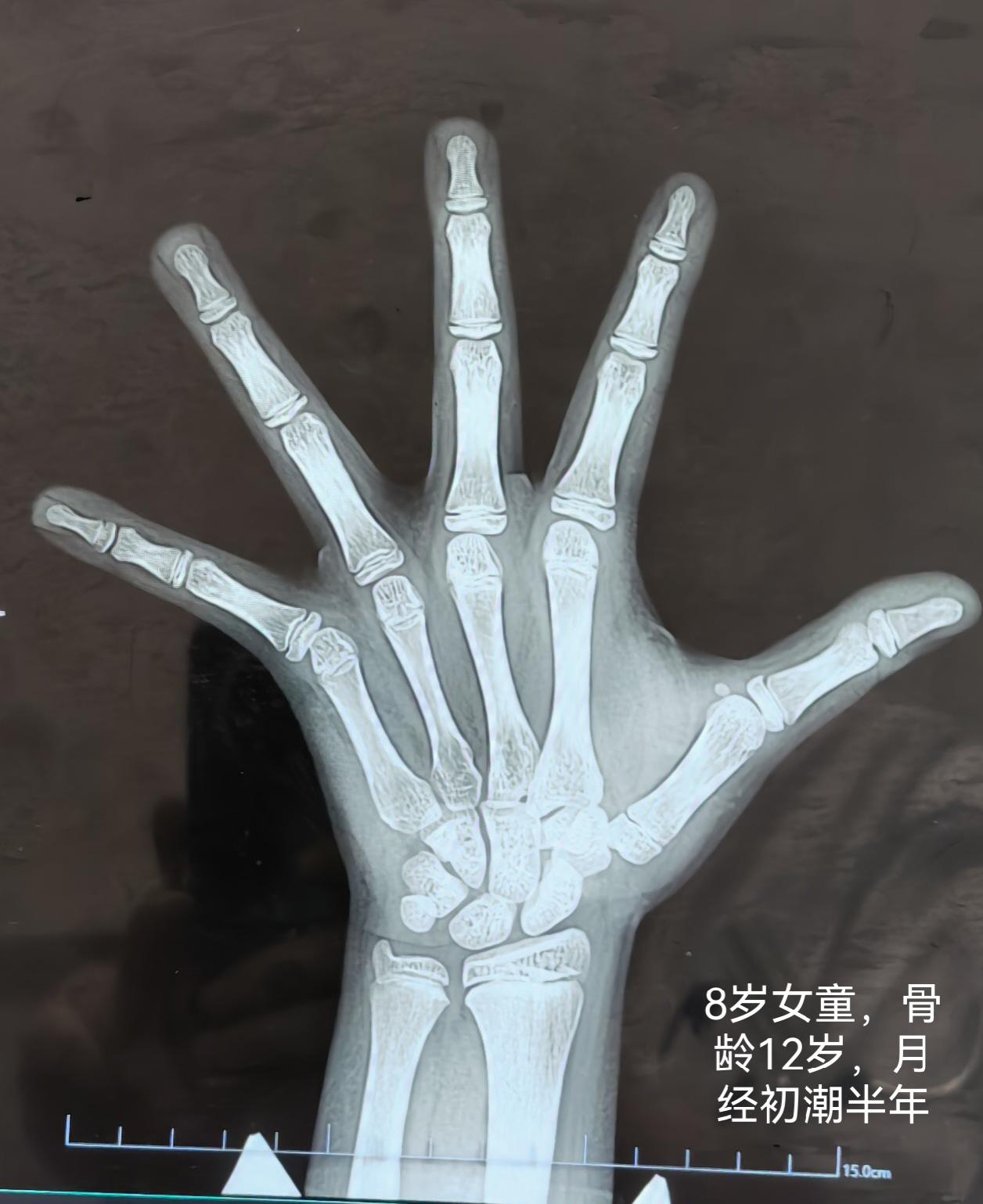 女孩子，8岁，月经初潮，家长心急火燎，他们知道女孩子青春期9—10岁开始，12岁